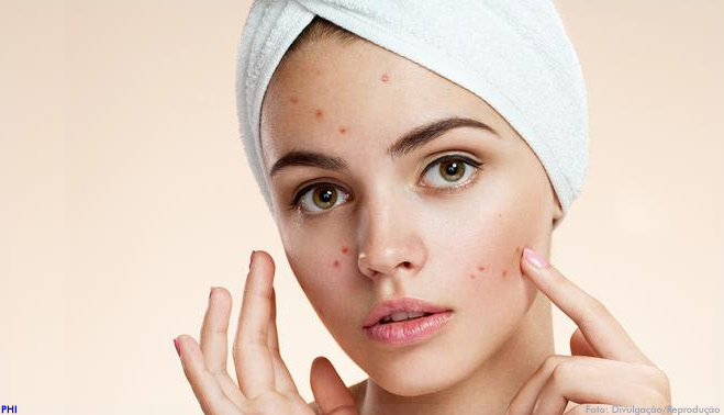 Estudo realizado em gêmeos apontou predisposição genética como fator desencadeante para a acne