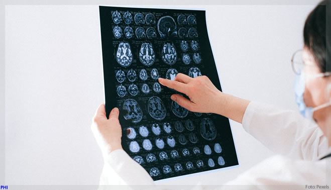 Diurético se mostra promissor e vira nova esperança no tratamento do Alzheimer