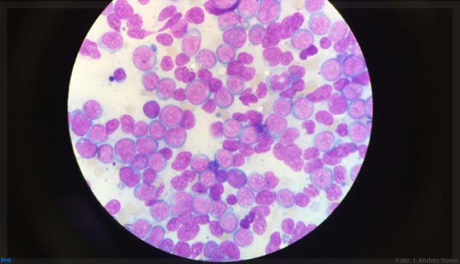 Descoberta mutação genética que desencadeia leucemia aguda grave